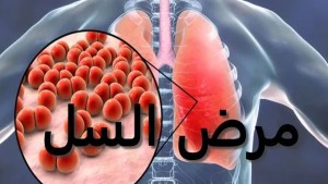 وزارة الصحة : تسجيل 22 حالة جديدة بمرض السل لكل 100 ألف ساكن