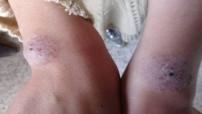 معهد باستور: عدد الإصابات بليشمانيا الجلدية في تونس يص الى 5 آلاف إصابة