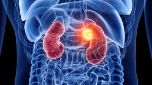 اليوم العالمي للكلى: جمعية طب الكلى تنصح بعدم الإفراط في تناول المسكنات