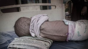 500 رضيع في مستشفيات غزة بسبب الجوع وسوء التغذية