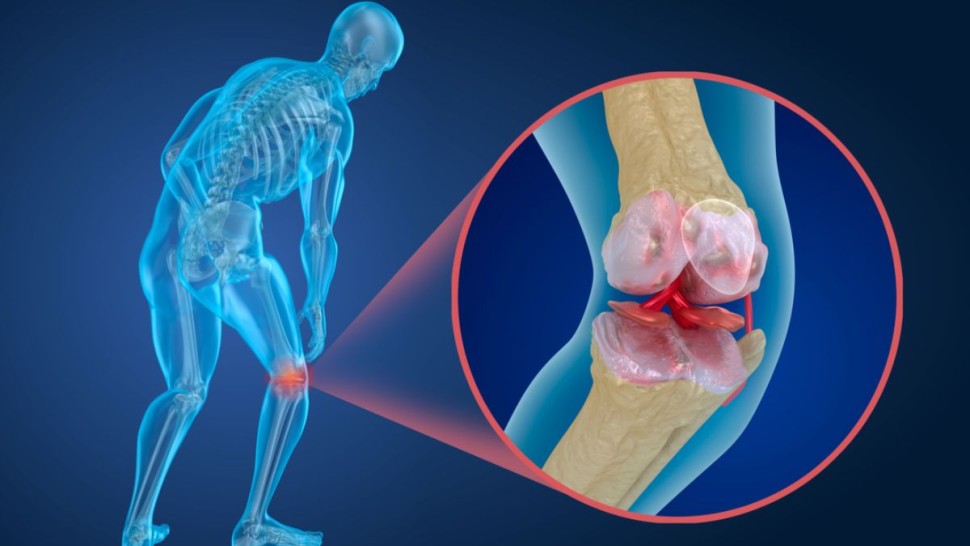 تآكل غضروف الركبة يصيب بين 30 الى 40 بالمائة من يفوق سنهم 45 سنة