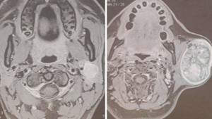 سيدي بوزيد: نجاح أوّل عمليّات جراحية نوعيّة على الغدّة النكفيّة بالمستشفى الجامعي