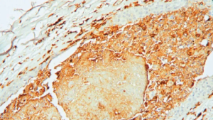 دراسة: السرطان يُربك الساعة البيولوجية للدماغ ويضعف استجابة الجسم