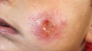 عميد البياطرة يدعو الى مقاومة القوارض والبعوض للوقاية من مرض اللشمانيا