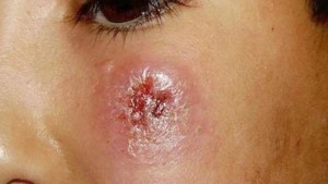 حاجب العيون: تسجيل أكثر من 100 إصابة باللشمانيا