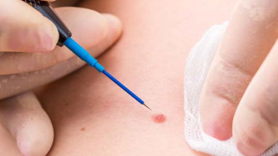 فيروس الورم الحليمي يسبب سرطانات البلعوم الفموي واللوزتين والسرطانات التناسلية