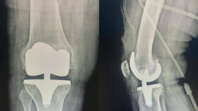 جندوبة: نجاح عملية تركيب مفصل اصطناعي كامل للركبة بالمستشفى الجهوي