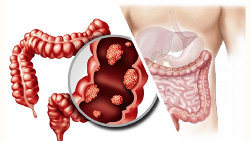 سرطان القولون