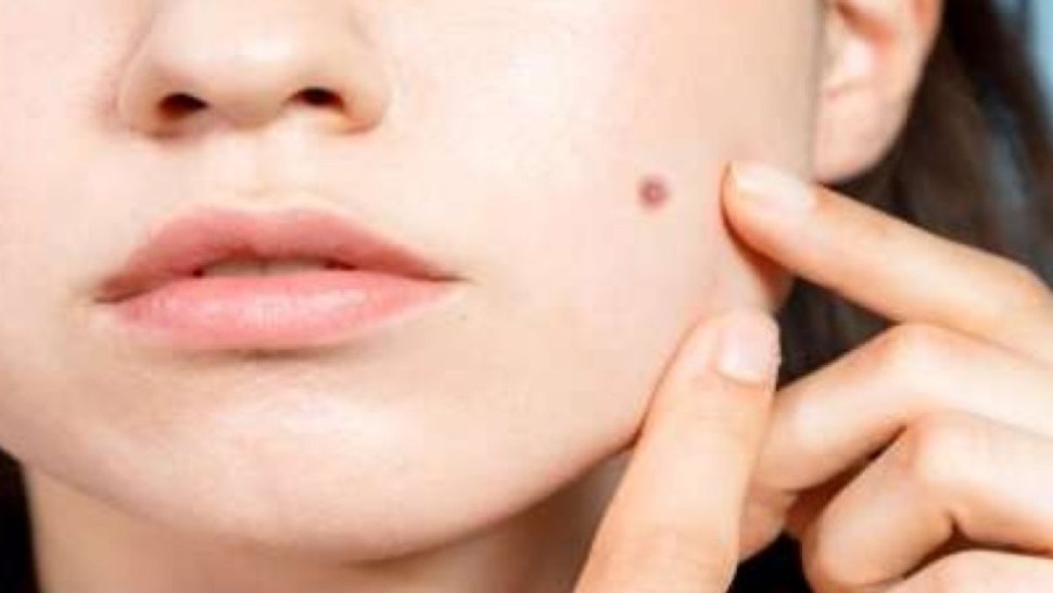 طبيبة : بعض الشامات الجلدية قد تخفي أمراضاً خطيرة مثل السرطان