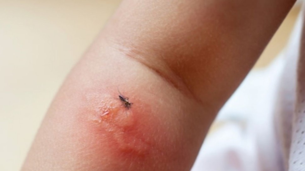 قفصة: 1460 إصابة بالليشمانيا خلال سنة 2025