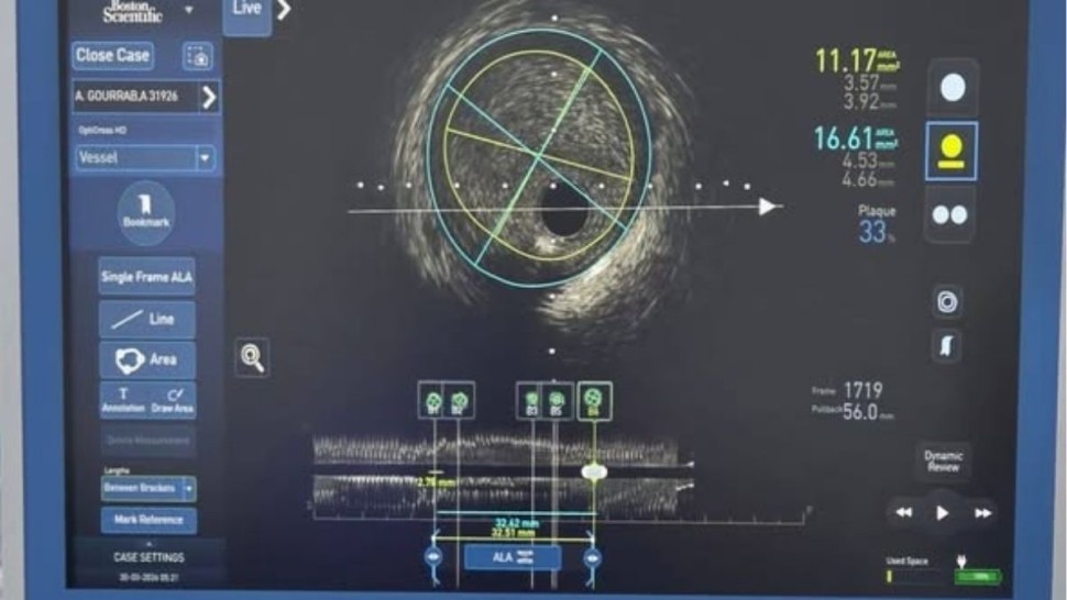 مستشفى الرابطة : استعمال دعامة تاجية من الجيل الثالث حصريّا في إفريقيا