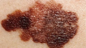 علاج جديد لسرطان الجلد يقلل خطر الوفاة وعودة المرض بنحو 50 %